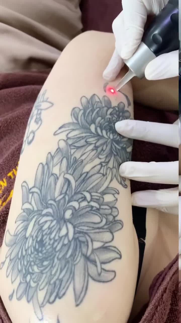 Xóa xăm hình buổi 1