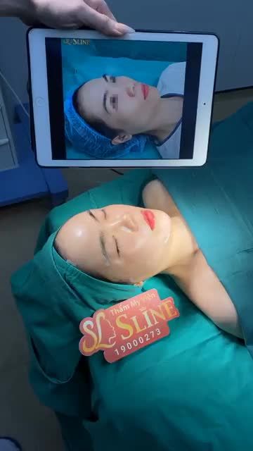 CẤY MỠ TỰ THÂN - HỒI XUÂN CHỈ SAU 1 LẦN THỰC HIỆN