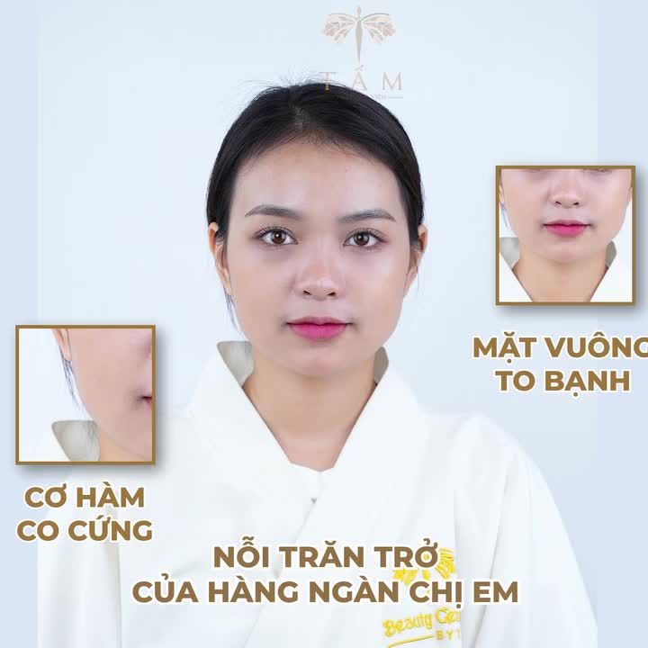 VLINE PERFECT - BÍ QUYẾT SỞ HỮU KHUÔN HÀM THON GỌN, ĐẸP CHUẨN VLINE