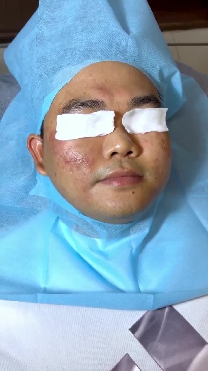 Quý ông khổ sở vì SẸO RỖ LÂU NĂM được bác sĩ JW CẢI THIỆN LÀN DA sau 3 buổi điều trị