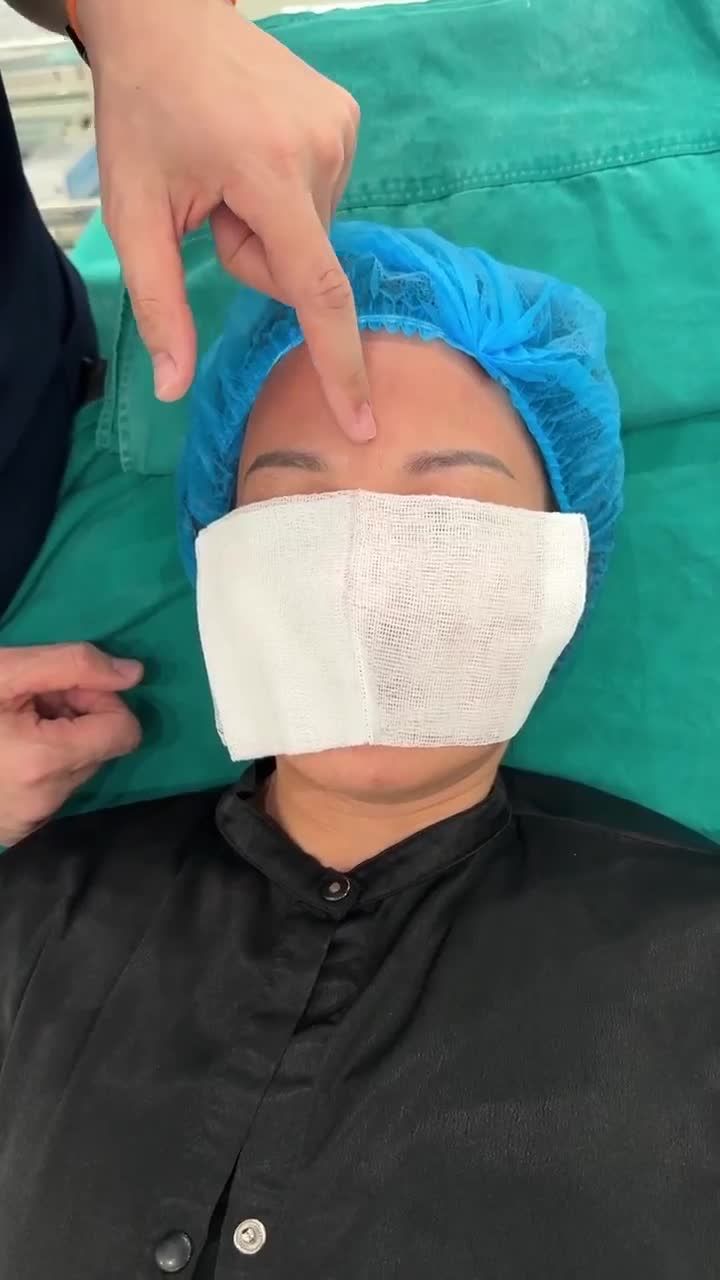 BÁC SĨ ĐIỀN TIÊM XÓA NHĂN CAU MÀY CHO CHỊ KHÁCH HÀNG SAU KHI ĐÃ TIÊM LÀM ĐẦY RÃNH MŨI MÁ.