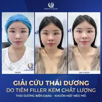 CẢNH BÁO - Tiền mất, tật mang. Khi tiêm filler kém chất lượng vào thái dương.