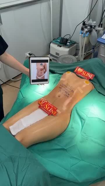 COMBO CHÀO HÈ SIÊU HOT CỦA SLINE:  NÂNG V1 + HÚT MỠ SIẾT EO 360