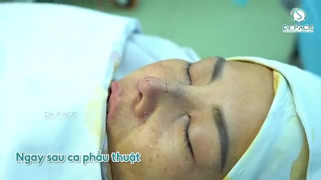 Xem thêm 2425 video Nâng Mũi của bác sĩ Bs Trần Phương