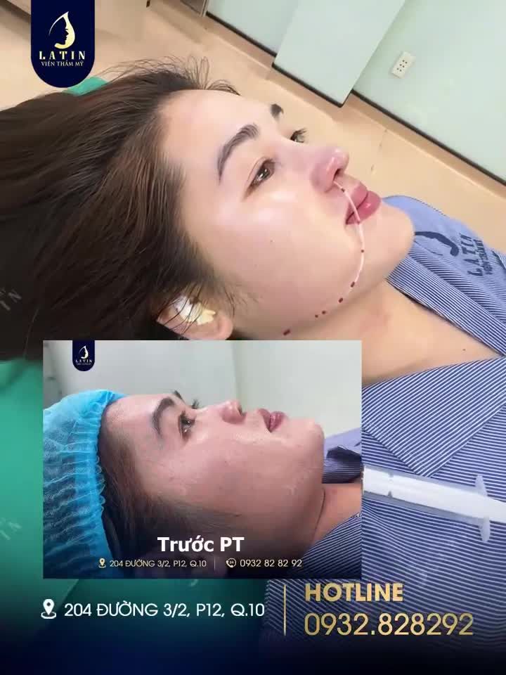 Kết quả nâng mũi cấu trúc sụn tai, thu nền mũi cho chị khách đến từ Đồng Nai