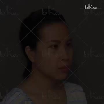 KẾT QUẢ THẨM MỸ SAU TIÊM MỠ TỰ THÂN, NÂNG MŨI NHƯ THẾ NÀO?