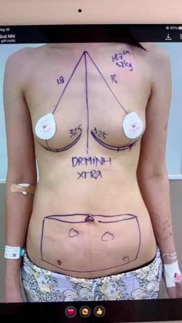 CA COMBO NÂNG V1 + HÚT MỠ