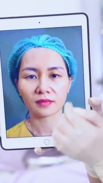 1 giờ 30 phút sở hữu đôi mắt tự tin, rạng rỡ với Combo Cắt mí + Nâng cung mày tại Dr.Hải Lê!
