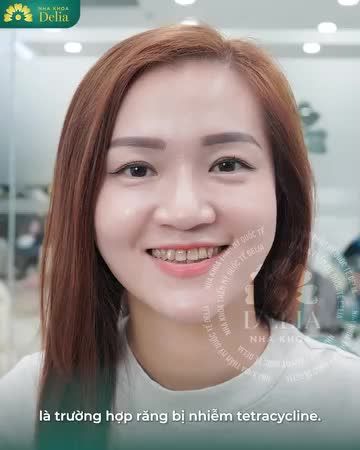 Có một sự thật là: 60-70% khách hàng đến Delia làm răng sứ để khắc phục răng nhiễm Tetracycline.