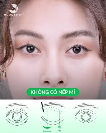 15 phút biến nếp mí từ không thành có