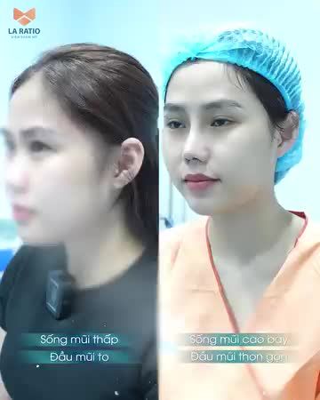 Nâng mũi chuẩn đẹp như Song Hye Kyo sau 45 phút bởi ekip bác sĩ chuyên môn La Ratio trực tiếp thực hiện Lên đời nhan sắc hóa thành hotgirl