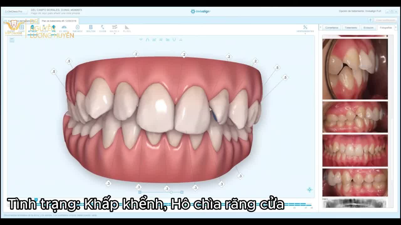 CLINCHECK INVISALIGN Răng hô chìa, khấp khểnh
