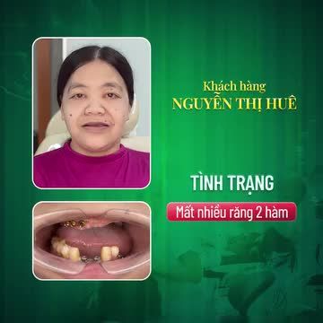 Mất nhiều răng hàng chục năm rồi Không có phương án điều trị, cứ để nguyên như vậy 3 chiếc răng hàm trên lung lay không ăn nhập với xương hàm Có hiện tương tiêu xương