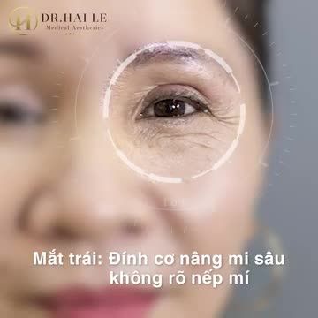 Đột phá nhan sắc sau sửa mí tại Dr hải Lê