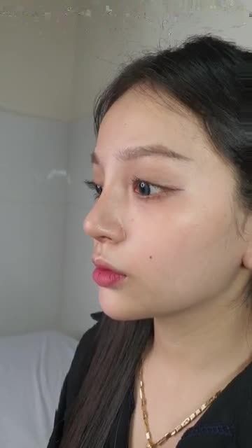 Thay đổi sau 12 ngày Nâng Mũi Aline cho bạn khách xinh đẹp