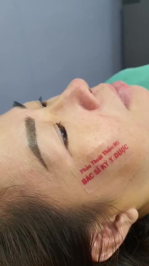 Tạm biệt mũi lộ sụn, đón mũi cao sang. Chỉ sau 60 phút phẫu thuật, từ 1 chiếc mũi: