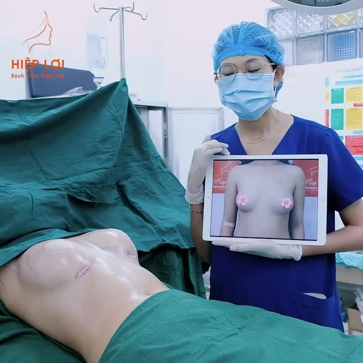NÂNG CẤP VÒNG 1 - 205 CC với dòng túi ngực cao cấp chỉ sao 40 phút