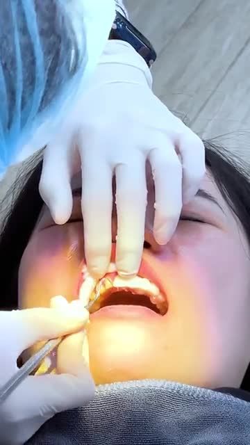 QUÁ TRÌNH THẨM MỸ 16 ĐƠN VỊ RĂNG SỨ CHO MỘT NỮ KHÁCH HÀNG