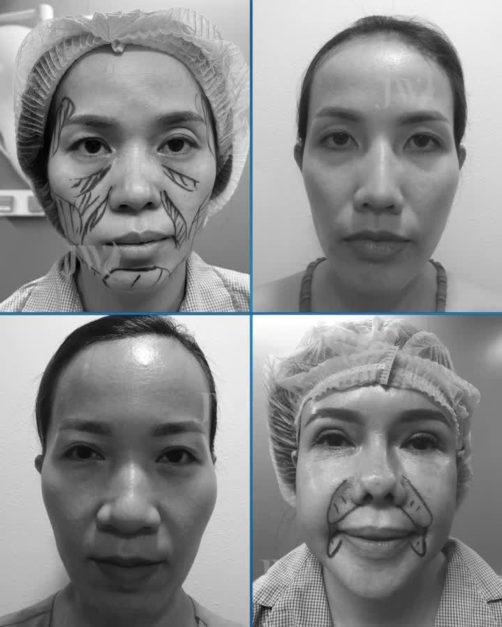 BẬT MÍ quy trình Cấy mỡ mặt Baby Face TRẺ 20 TUỔI