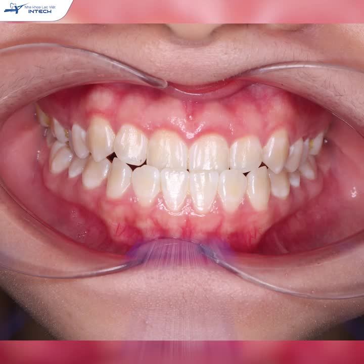 ĐAU MỎI HÀM KHI NGỦ, CÔ GÁI ĐI KHÁM RĂNG VÀ NHẬN KẾT QUẢ ƯNG Ý SAU 2 NĂM!