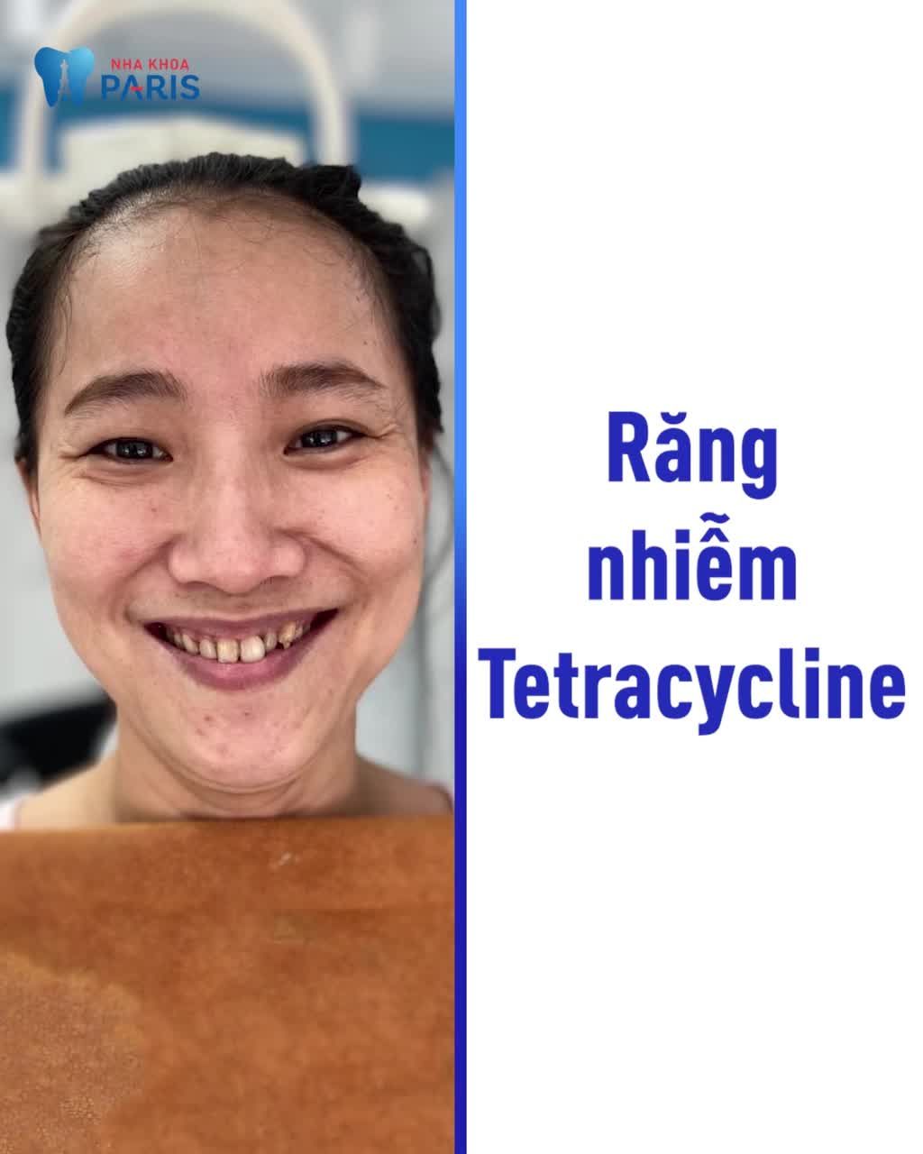 Bọc răng sứ an toàn cùng chuyên gia tại Viện răng sứ thẩm mỹ Paris - Nha khoa Paris: