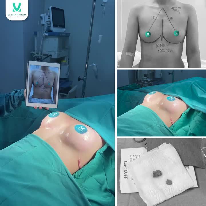 Nâng cấp "tâm hồn" với dáng V1 SIÊU MỀM trị “lépmãn tính” với công nghệ độc quyền Dr. Minh Phạm: Thiết kế dáng V1 an toàn đẹp mềm mại tự nhiên