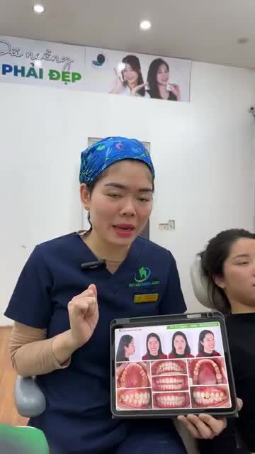 Cận cảnh ca gắn mắc cài bắt đầu quá trình chỉnh nha kéo răng ngầm, khắc phục tình trạng răng hô cho bạn Ngọc tại Nha khoa Thuỳ Anh.