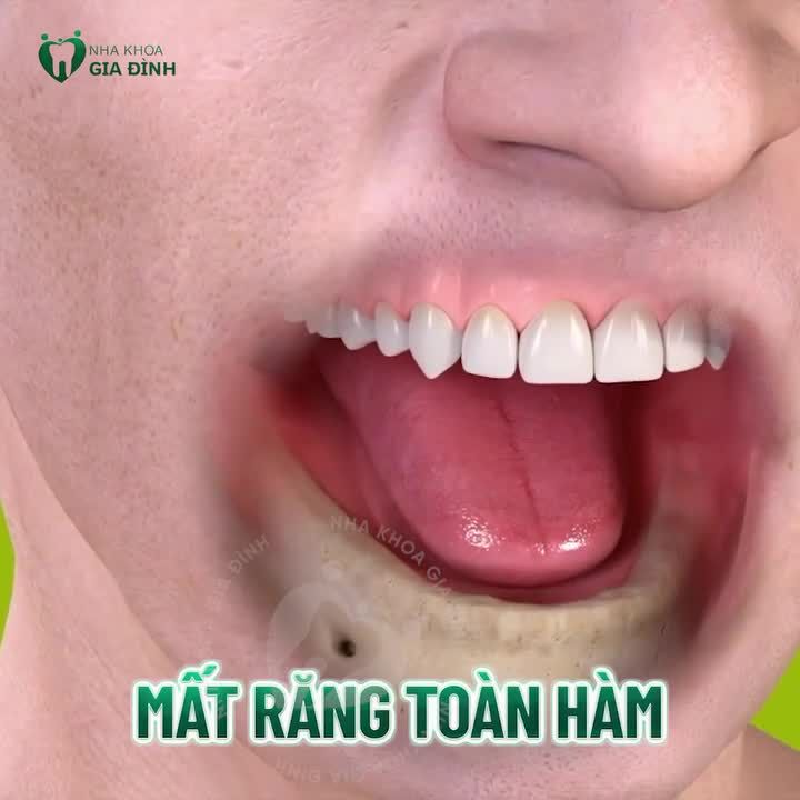 TRỒNG RĂNG IMPLANT TỨC THÌ: TIẾT KIỆM THỜI GIAN - TỐI ƯU CHI PHÍ
