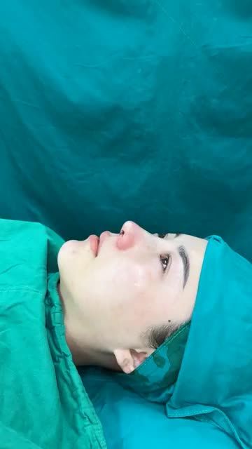 Case mũi cấu trúc sụn Surgiform cho bạn gái đến từ Gia Lai vừa hoàn thành!!