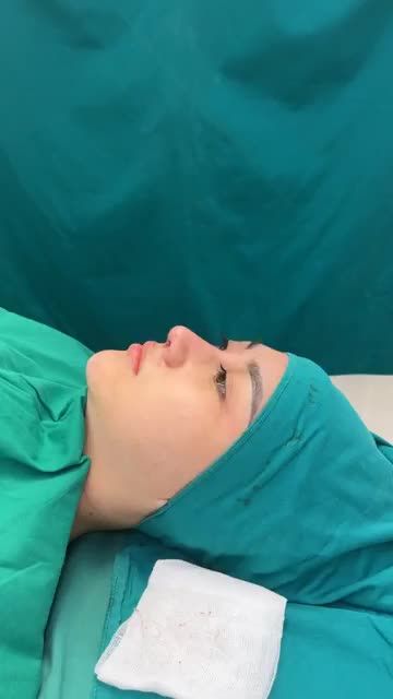 Case mũi cấu trúc bóc chỉ vừa hoàn thành