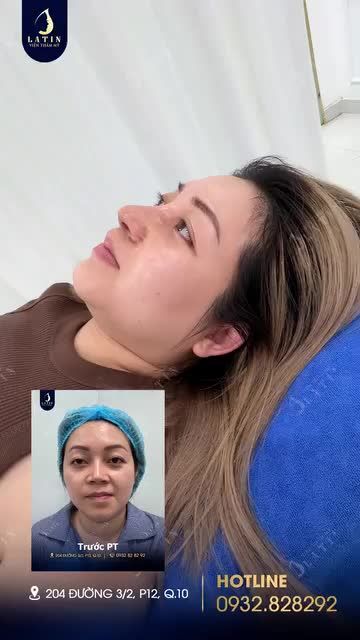 Chị em nào đang muốn nâng mũi mà sợ đau, sợ sẹo thì xem ngay video này nhé!