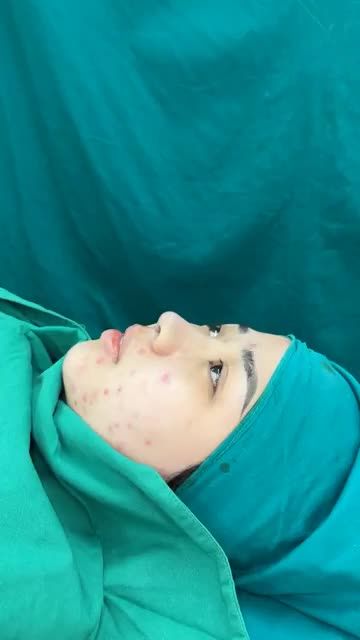 Case mũi cấu trúc - Khắc phục hoàn toàn tình trạng mũi thấp tẹt, ngắn hếch!!