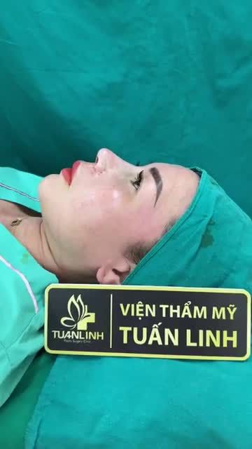 Ca nâng mũi cấu trúc sửa lại cho chị khách việt kiều Đài Loan đã từng nâng mũi được 10 năm  Cả nhà cùng theo dõi nha!