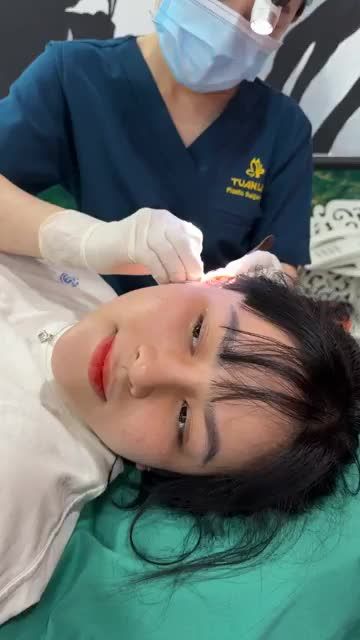 Case mũi cấu trúc 10 ngày
