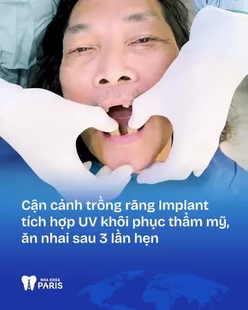 GIẢI PHÁP MỚI RÚT NGẮN THỜI GIAN TRỒNG RĂNG 4 THÁNG CHỈ CÒN 1,5 THÁNG