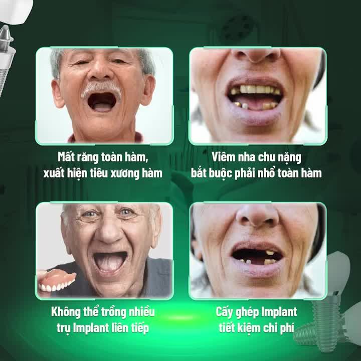 GIẢI PHÁP NÀO CHO CÔ CHÚ, ANH CHỊ MẤT RĂNG TOÀN HÀM?