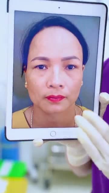 Cắt mí dưới + Nâng cung mày Dr.Hải Lê - Sở hữu gương mặt tươi trẻ, rạng rỡ!
