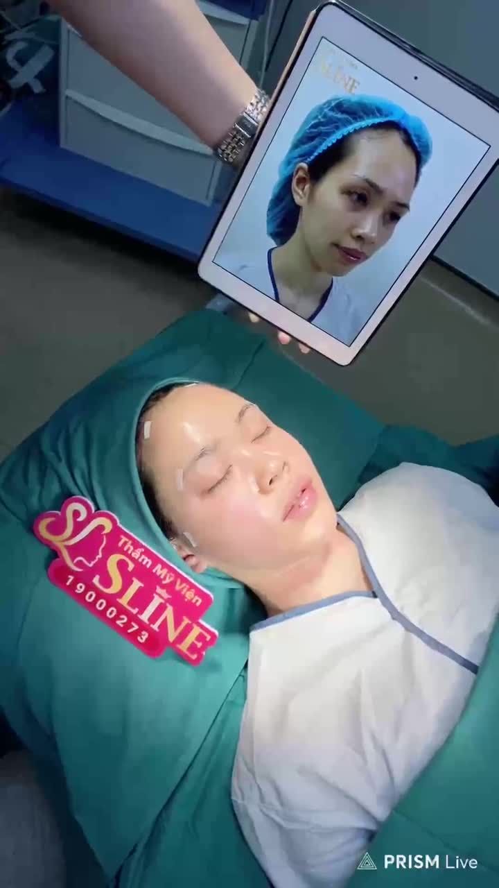 CẤY MỠ MẶT VỚI CÔNG NGHỆ SÚNG CẤY MỠ MAFT-GUN