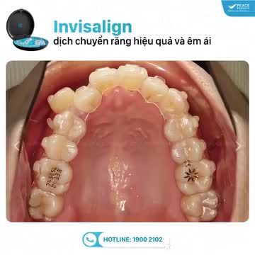 Xem thêm 23 video Niềng Răng Invisalign của bác sĩ Bs nha khoa Peace Dentistry