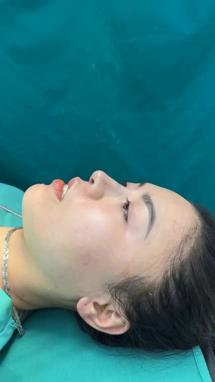 Case mũi cấu trúc sửa lại cho bạn gái đến từ Trà Vinh!!