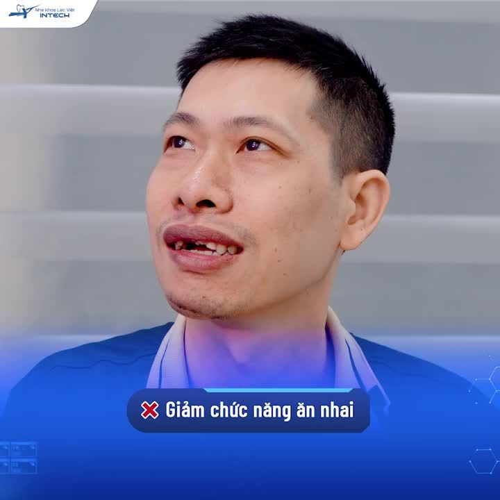 MẤT 3 RĂNG CỬA HÀM TRÊN ĐÃ THAY ĐỔI NGOẠN MỤC NHỜ GIẢI PHÁP TRỒNG RĂNG IMPLANT DCT