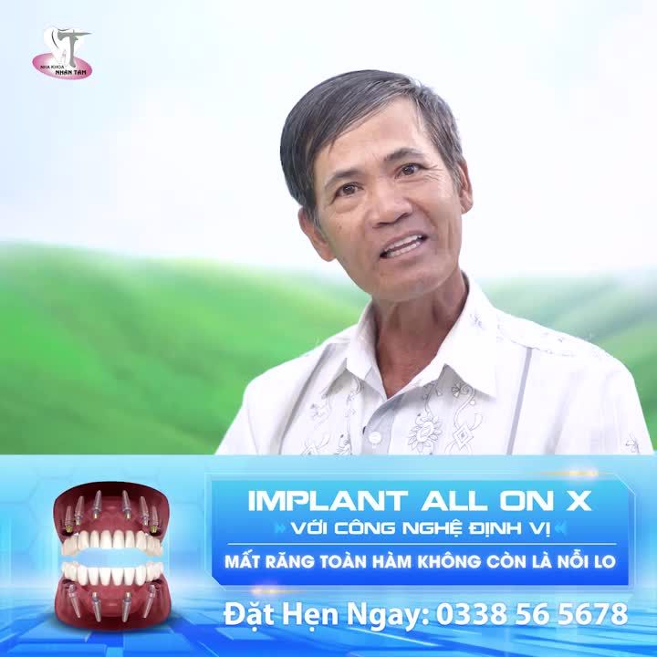 Implant All On X - Trồng một lần, dùng trọn đời