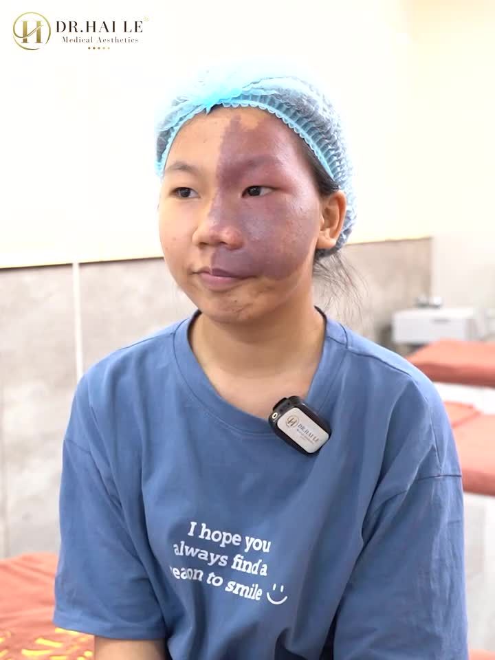 Chàm, bớt bẩm sinh tuy không ảnh hưởng đến sức khỏe nhưng lại gây ra sự tự ti, mặc cảm cho nhiều người gặp phải tình trạng này