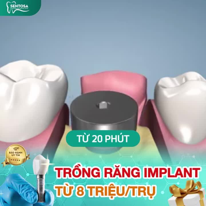 IMPLANT TRỒNG RĂNG GIẢ ĂN NHAI TRỌN ĐỜI TỪ 8 TRIỆU/TRỤ