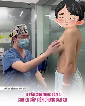 TƯ VẤN SỬA NGỰC LẦN 4 CHO KH GẶP BIẾN CHỨNG BAO XƠ.