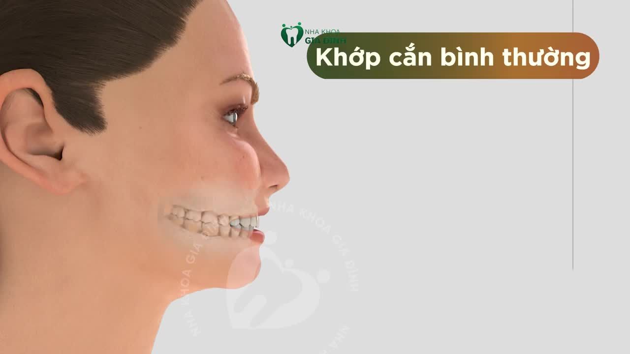 HÀM CHỈNH NHA FACEMASK - HỖ TRỢ ĐIỀU TRỊ KHỚP CẮN NGƯỢC Ở TRẺ