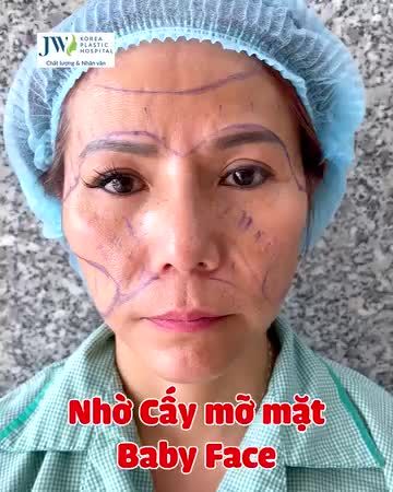 Quý cô U60 MẶT GẦY TRƠ XƯƠNG bỗng chốc TRẺ 20 TUỔI nhờ CẤY MỠ MẶT BABY FACE