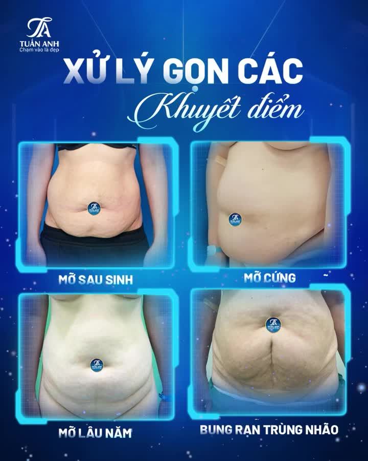 Mất tự tin vì mỡ sau sinh, mỡ cứng, mỡ lâu năm
