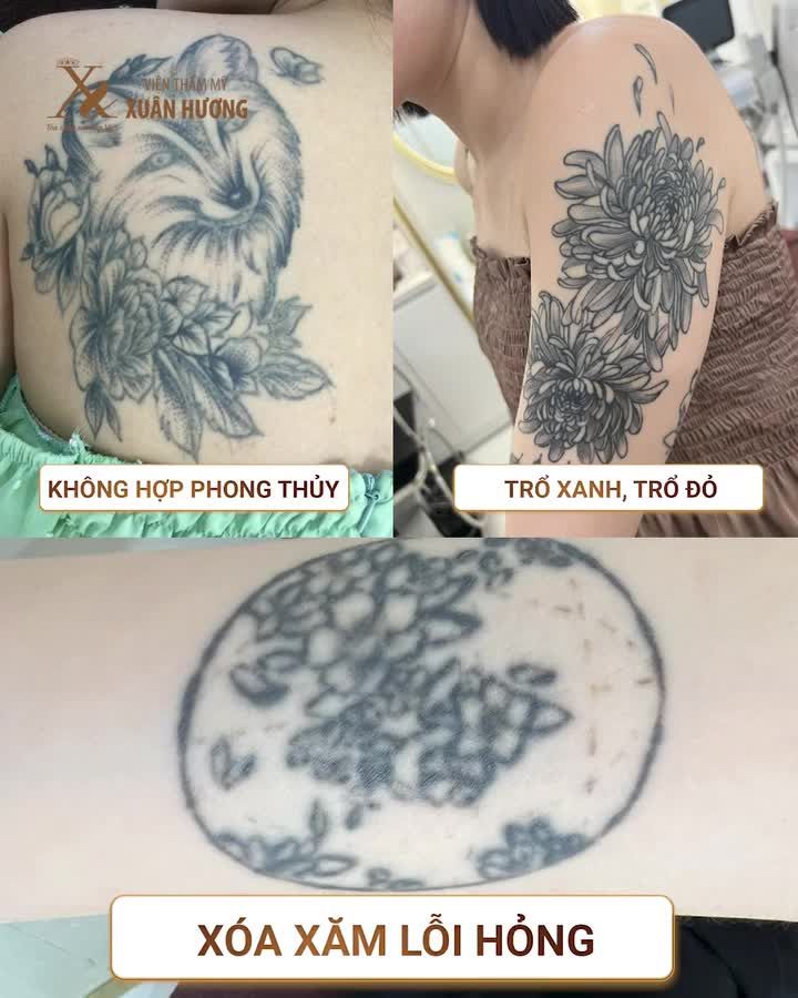 Xóa xăm không đau - không sẹo - không biến chứng chỉ có thể là Melas Picosure