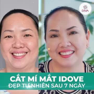 CẮT MÍ MẮT IDOVE – MÍ ĐỀU – MẮT TO CUỐN HÚT